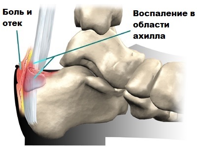 Ахиллесова Сухожилия Где Находится Фото